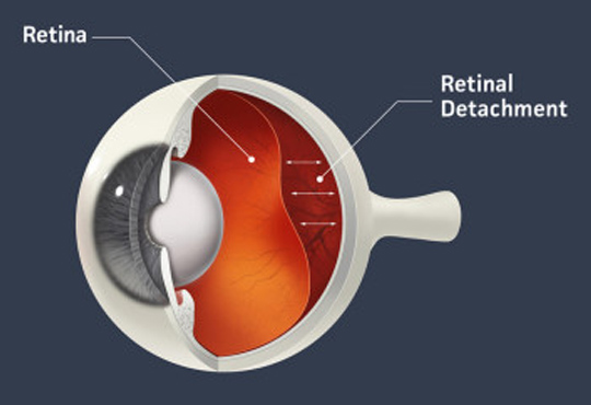 Descolamento de retina: sintomas e tratamento